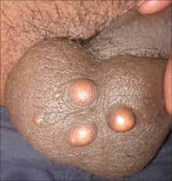 Cysts Of The Penis 2